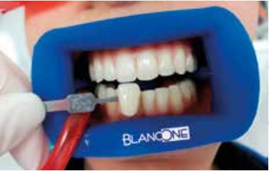 APRIBOCCA BLANCONE - Offerte Dentali